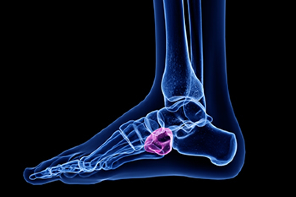 Cuboid Syndrome and Pain Along the Outer Foot