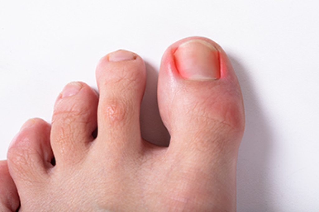 What Causes an Ingrown Toenail?