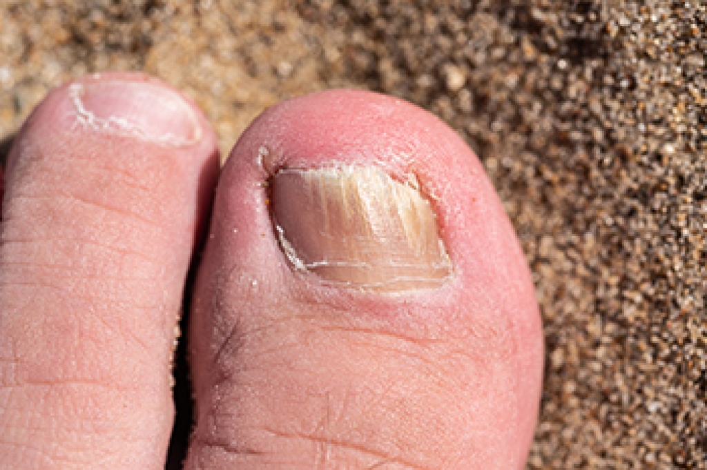 Toenail Fungus Can Cause Thick and Discolored Nails