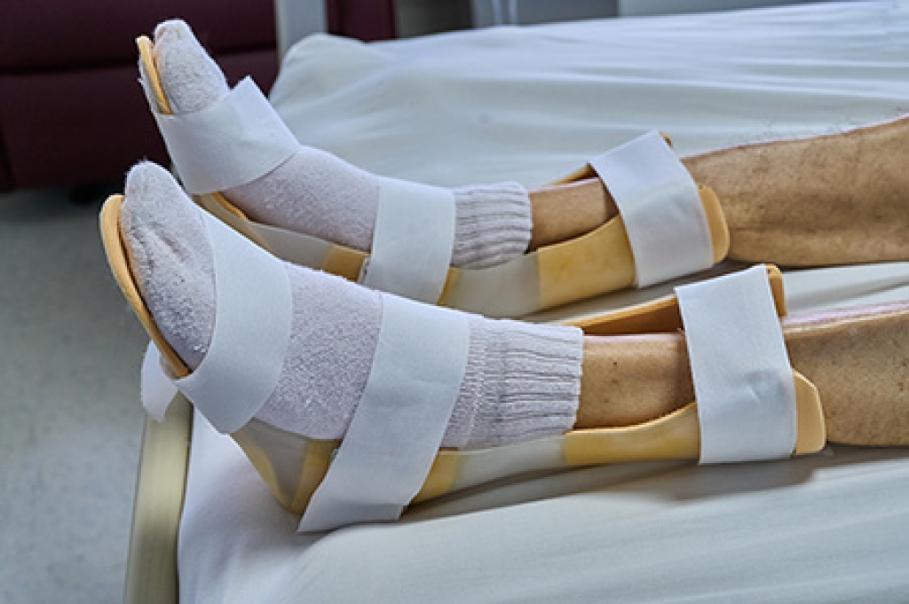 Night Splints Can Ease Morning Heel Pain