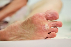 Where Are Plantar Warts Found?