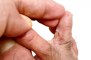Causes of Corns