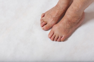 What Is a Hammertoe?