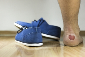 Preventing Blisters