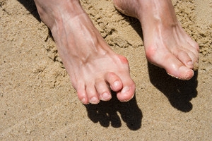 What Is Hammertoe?