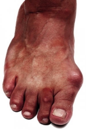 Why Do Bunions Develop?
