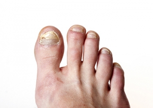 What Causes Toenails to Turn Yellow?