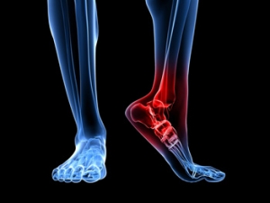 The Heel and Plantar Fasciitis