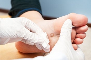 Recognizing and Treating Plantar Warts