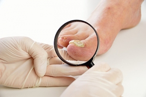Is Laser Treatment for Toenail Fungus Effective?