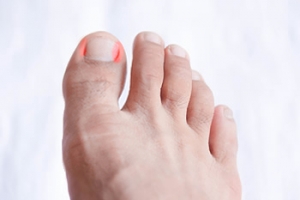 Causes of Ingrown Toenails