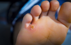 What Causes Corns?